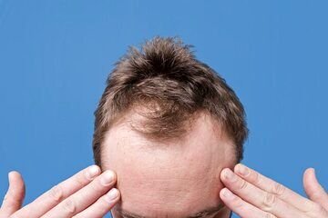 این نوع ریزش مو در مردان بسیار شایع است