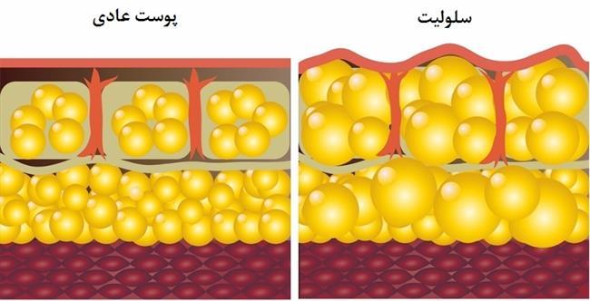 چرا سلولیت در بخش‌های خاصی از بدن شکل می‌گیرد؟