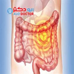 سرطان روده بزرگ را با 5 گام ساده از خود دور کنید