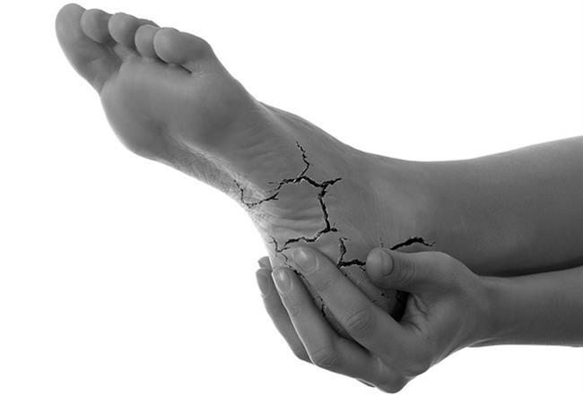 درمان ترک‌های پا