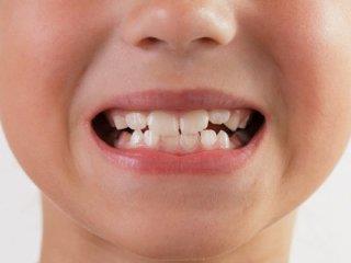 دندان قروچه کودکانه