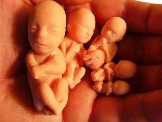 سقط مکرر و علت‌های آن