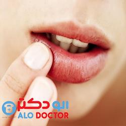 برای اینکه تبخال نزنیم چی بخوریم؟ +علائم، درمان و خوراکیهای مفید و مضر