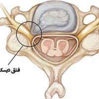 فتق دیسک؛ علائم، نشانه ها و راهکارهای مراقبتی