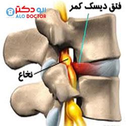 فتق دیسک کمر؛ 7علامت، 5 عامل و 8 راه درمان!