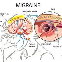 میگرن با تحریک الکتریکی درمان می‌شود