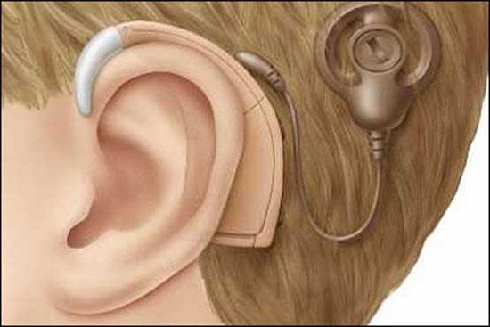 اختلال شنوایی و کاشت حلزون شنوایی