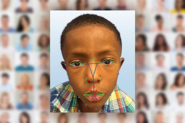 تکنولوژی تشخیص چهره در شناسایی نوعی بیماری نادر ژنی به پزشکان کمک می کند