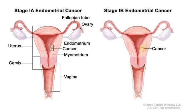 مرحله اول سرطان رحم