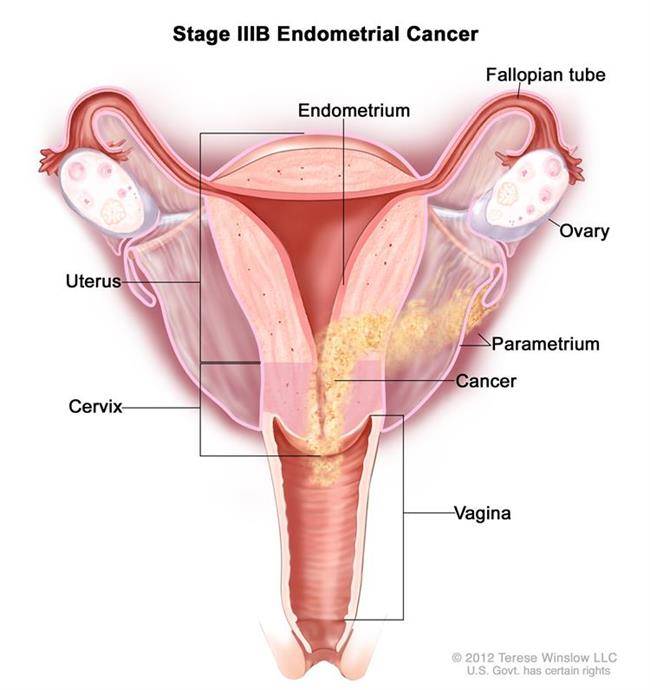 مرحله سوم سرطان رحم