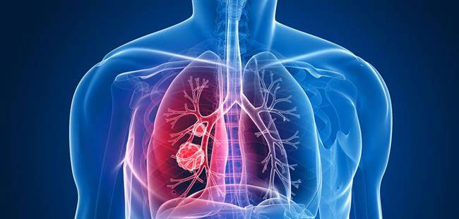 سرطان ریه : علل، علائم و درمان
