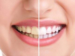 دانستنی هایی در مورد سفید کردن دندان‌هـا