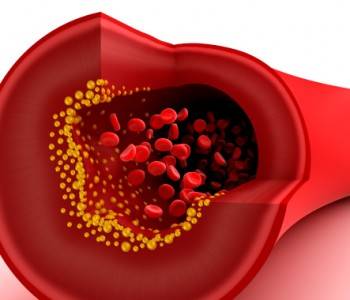 ‫ تصلب شرایین‬: علل، نشانه ها، پیشگیری و درمان