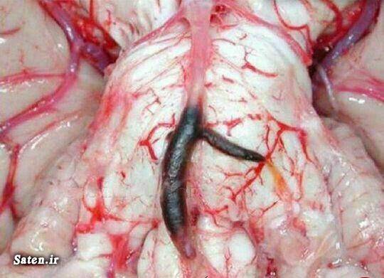 درون مغز بعد از سکته شدید مغزی + عکس مجله سلامت مجله پزشکی سکته مغزی تنظیم فشار خون پیشگیری سکته مغزی