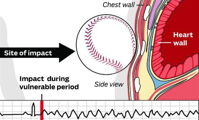 ct-chest-protector-commotio-cordis-graphic-w700