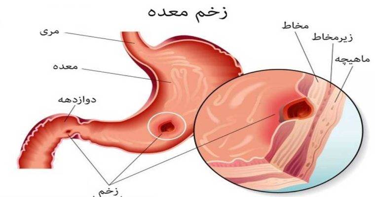 10 علت شایع که باعث زخم معده می شود