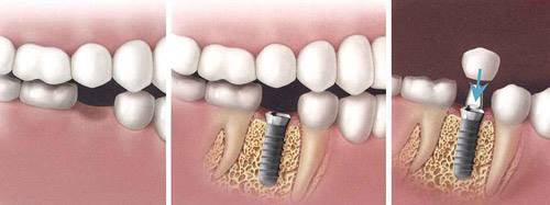 ایمپلنت؛ مطلوب ترین جایگزین دندان های از دست رفته