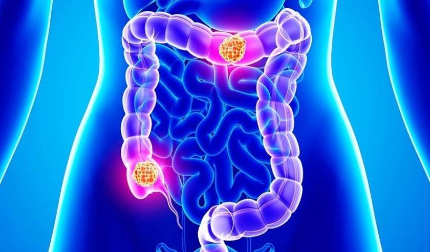 نشانه های سرطان روده بزرگ که زنان جوان باید آن را جدی بگیرند