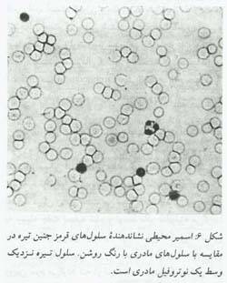 اختلالات ایمنی Rh در حاملگی(1)