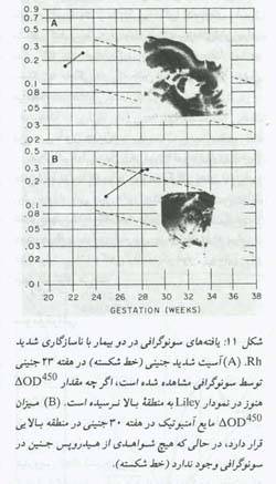 اختلالات ایمنی Rh در حاملگی(1)