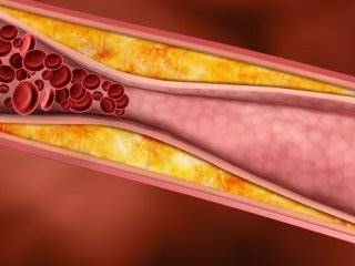 توصیه های مفید برای درمان آترواسکلروز