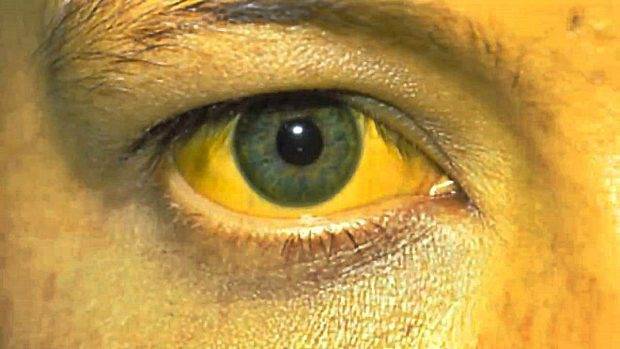 ictericia-ojos-amarillos-causas-a-620x349.jpg