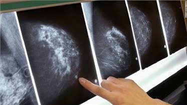 چند دلیل مهم برای انجام تست غربالگری سرطان سینه