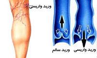 واریس در زنان2 برابر مردان