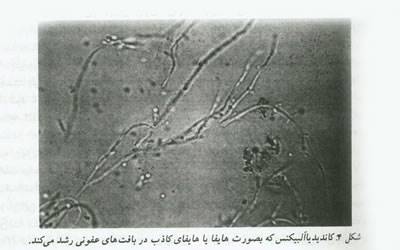 عفونت های لگنی و بیماری های منتقله از راه جنسی 