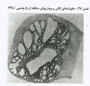 عفونت های لگنی و بیماری های منتقله از راه جنسی 