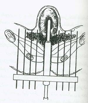 موارد مصرف پرتو درمانی در طب زنان