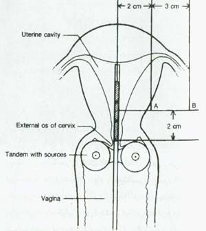 موارد مصرف پرتو درمانی در طب زنان