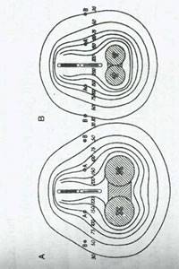 موارد مصرف پرتو درمانی در طب زنان