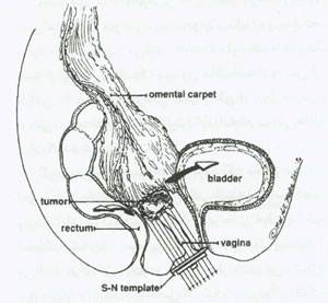 موارد مصرف پرتو درمانی در طب زنان