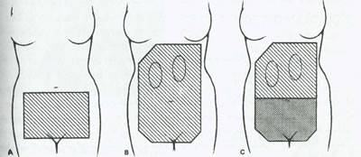 موارد مصرف پرتو درمانی در طب زنان