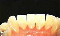 داروی آشکارساز پلاک دندان