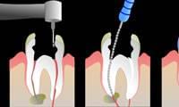 درمان مجدد ریشه دندان