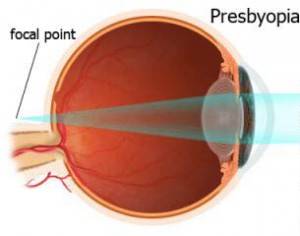 پیرچشمی ( Presbyopia ) چیست و چگونه پیشگیری و درمان می شود ؟