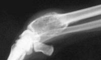 سرطان استخوان (Bone Cancer)