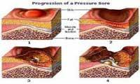 زخم های بستر (2)