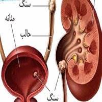 راه‌های تشخیص و درمان سنگ مثانه