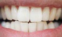 علت سایش دندانی