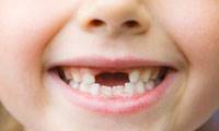 چگونه از دندان کودکان مراقبت کنیم؟
