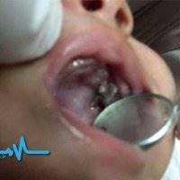 عکس/7 دندان نوزاد یکماهه با عمل جراحی خارج شد!