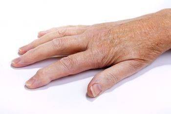 آرتروز التهابی