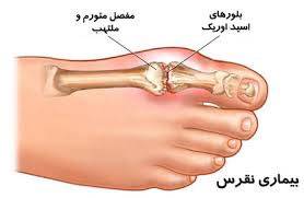 علل، علایم و روش‌های درمان‌ نقرس