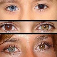 چرا رنگ 2 چشم برخی از افراد متفاوت است؟
