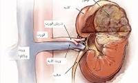 سرطان کلیه: علل بروز سرطان کلیه ، علایم و درمان آن