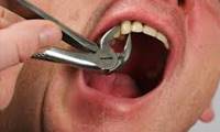 عفونت استخراج دندان
