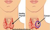علائم سرطان تیروئید در زنان
